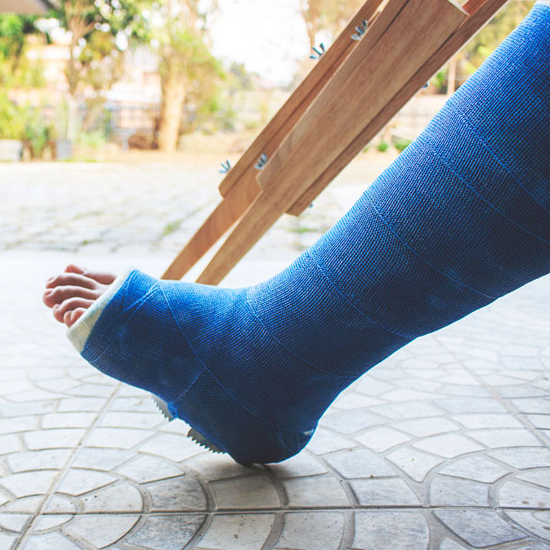 Bright Blue broken leg cast